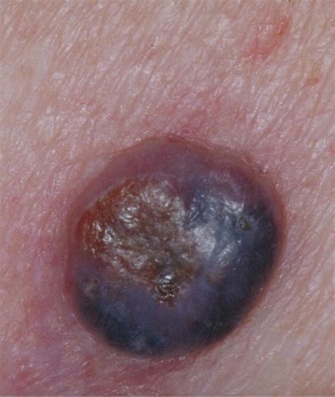 how big is nodular melanoma